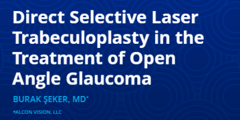 Direct Selective Laser Trabeculoplasty in the Treatment of Open Angle Glaucoma